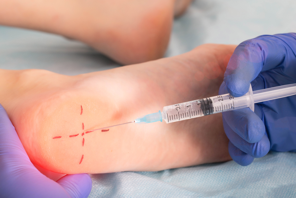 Cortisone injection in the heel for plantar fasciitis pain relief