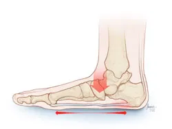 A diagram of a foot with a red line in the middle of it, illustrating flat feet