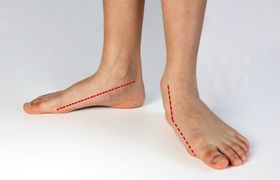 Conservative and Invasive Treatments for Flat Feet