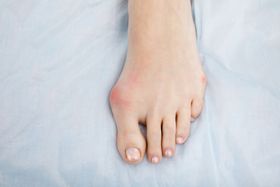 How to Prevent Bunions from Developing and Getting Worse