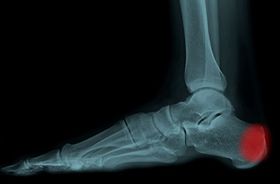 Insertional Achilles Tendonitis: Causes, Symptoms, and Treatment