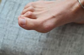 Best Exercises to Improve and Treat Your Hammer Toe