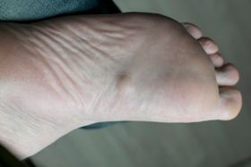 How to Massage Your Plantar Fibroma