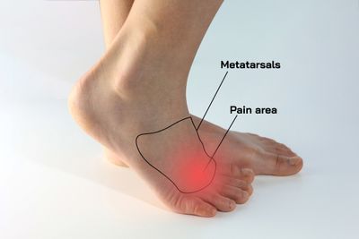 Anatomical representation of a foot highlighting areas affected by Morton's Neuroma.