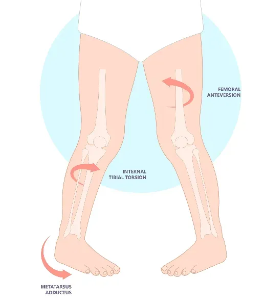 A diagram illustrating the condition metatarsus adductus that can cause pigeon toe walking in children and adults.