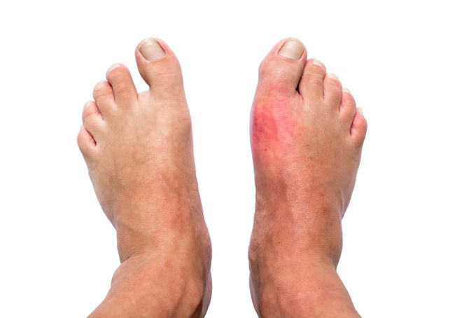 Male feet with inflamed gout on right foot