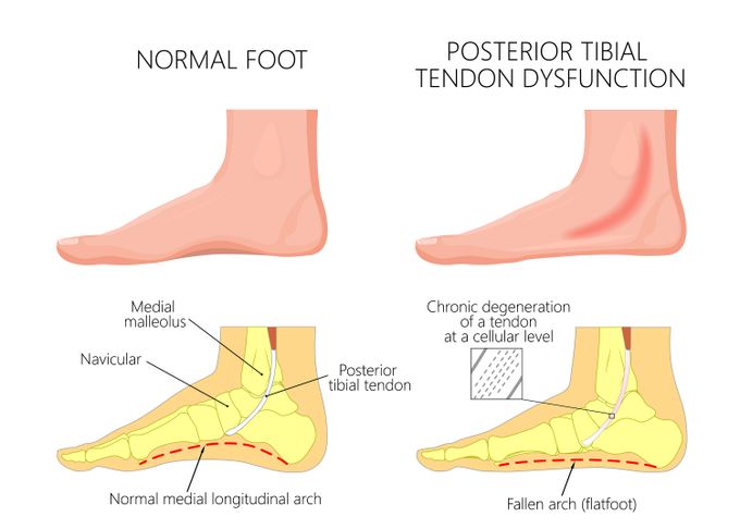 Illustration showing normal foot in comparison to a foot with posterior tibial tendon dysfunction