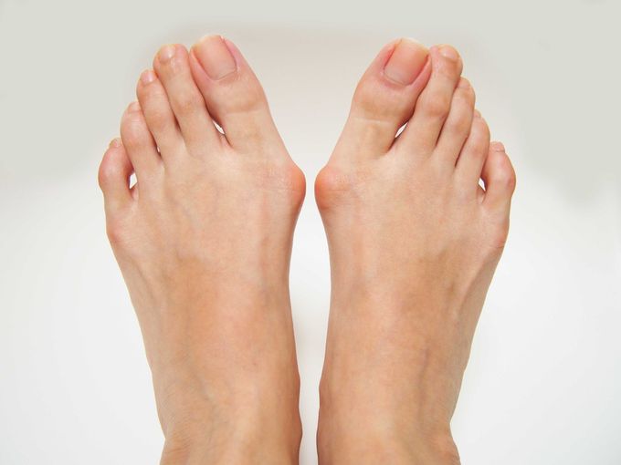 Female feet with protruding bunions