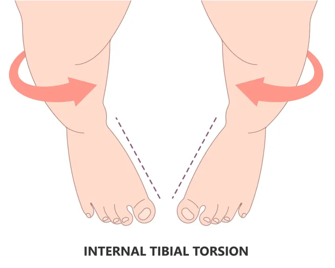 A diagram of a person's feet with a red arrow pointing  inwards to illustrate pigeon toe