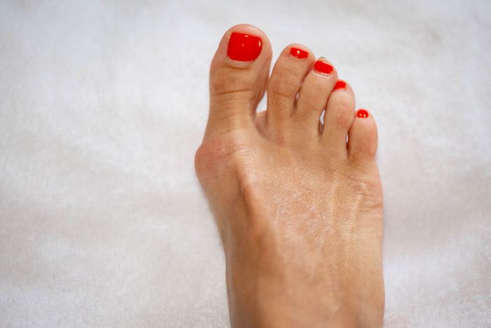 A woman's foot with a clear bulge on the bone of her big toe, with red nail varnish on her toenails, 