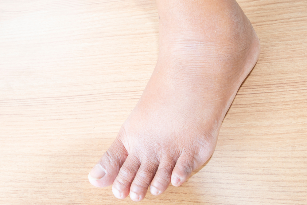 Foot Supination: Diagnosis, Causes, and Treatment - Custom